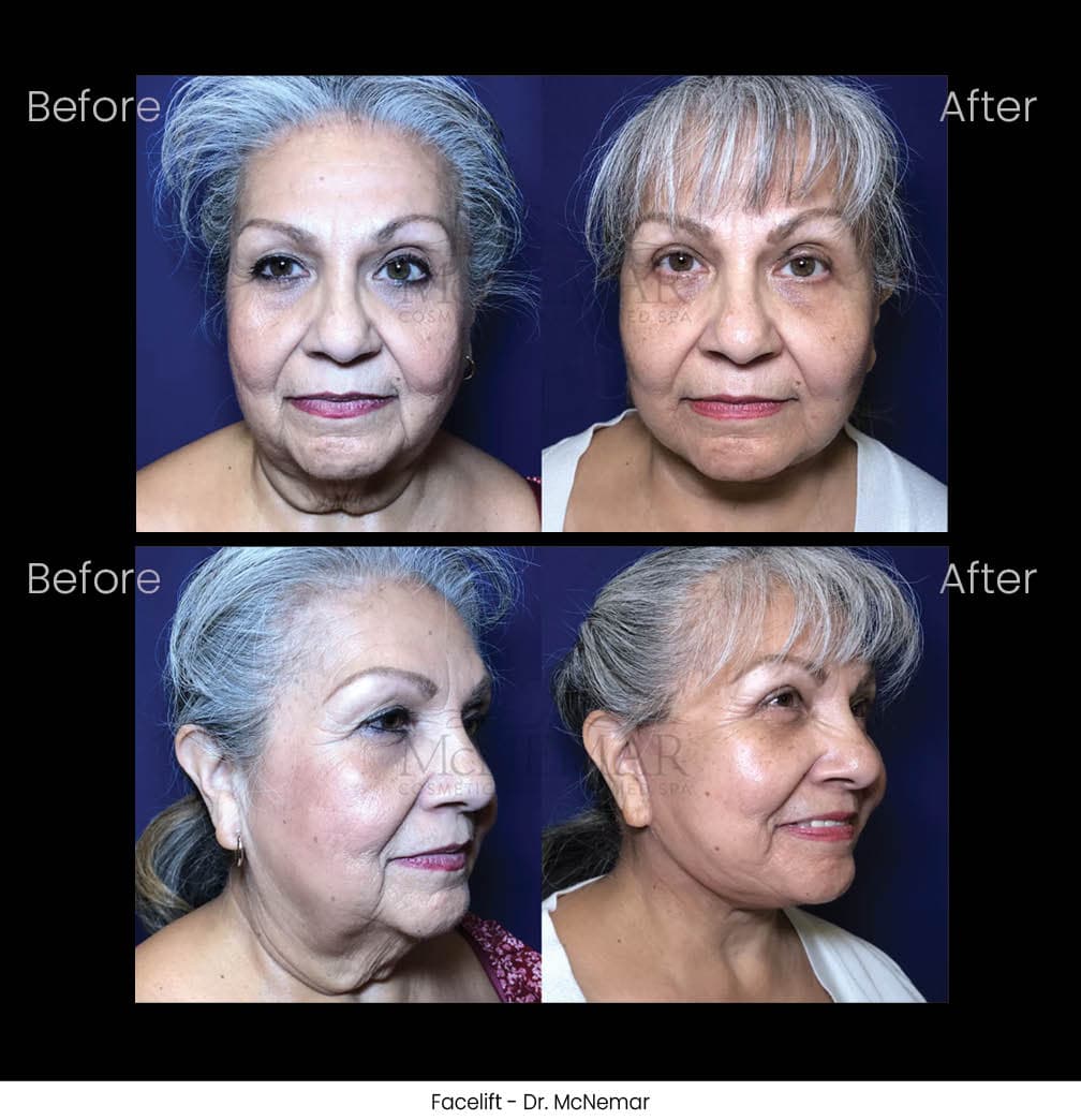 Facelift before and after results
