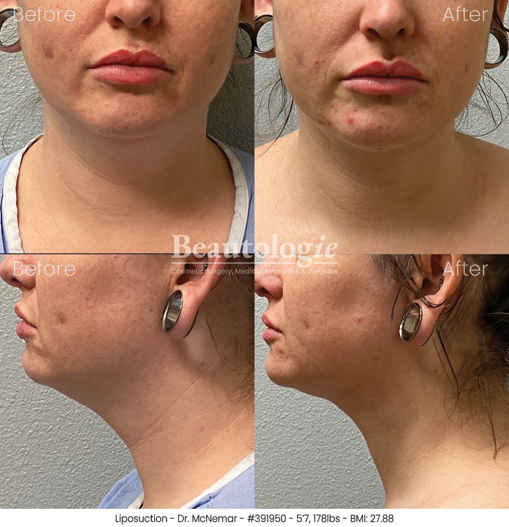 Liposuction before and after results