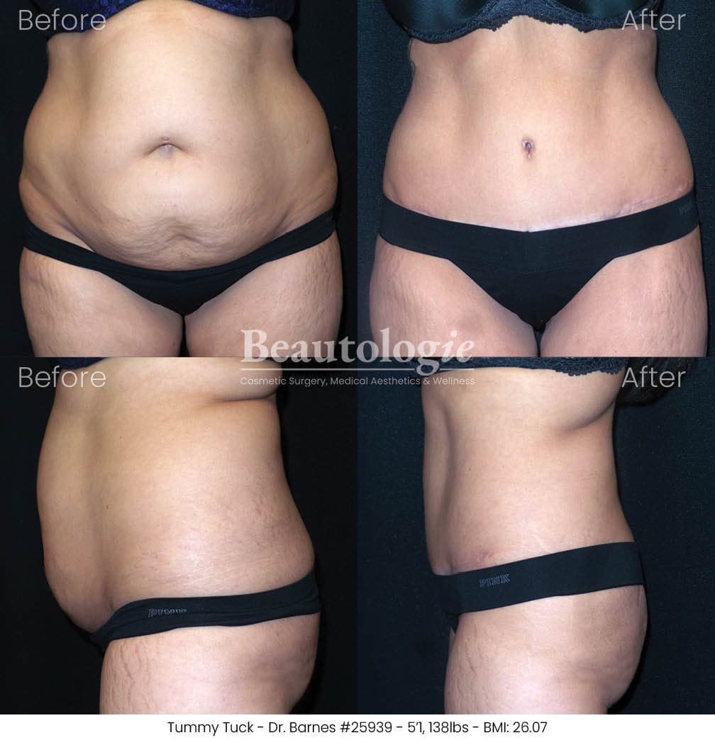 Tummy tuck before and after results