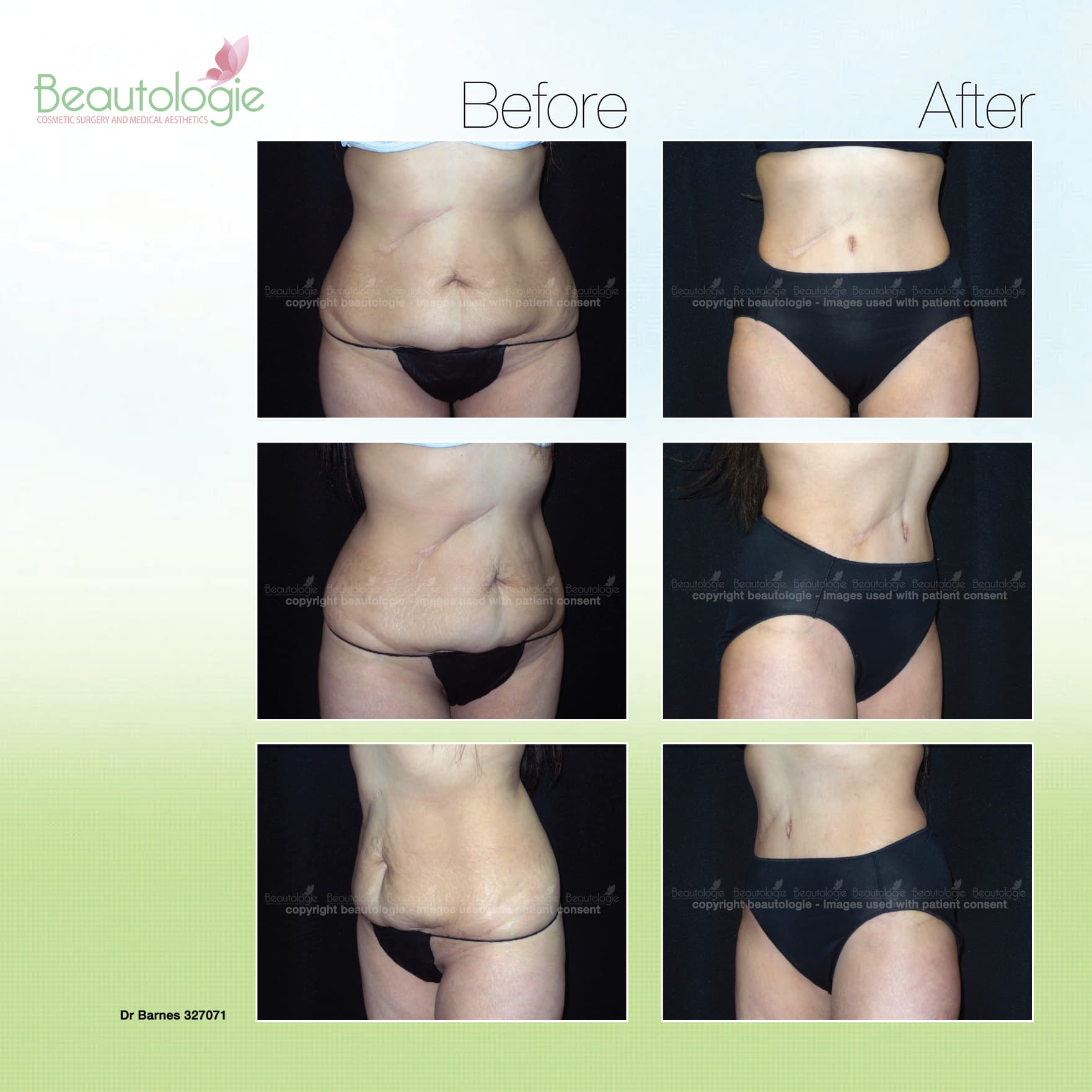 Tummy tuck before and after results